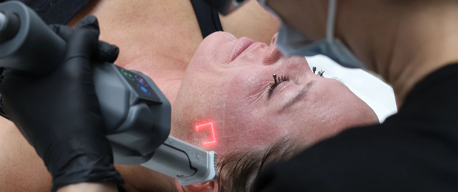 KAL-Lasers-CoolPeel